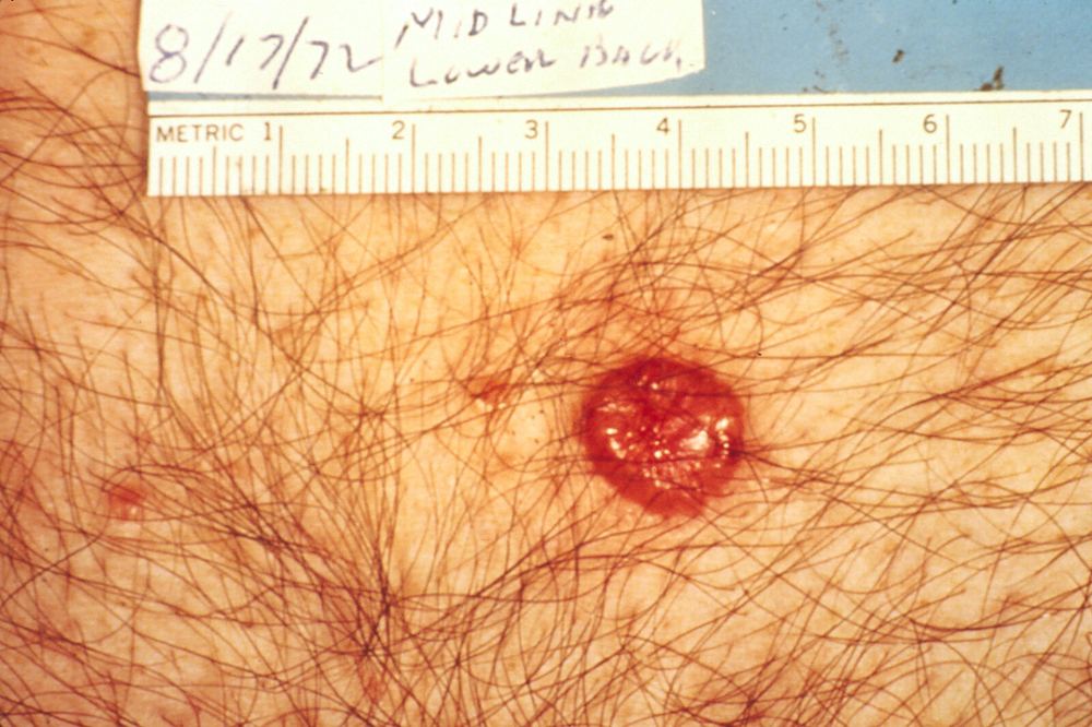 Clinical photograph of a red shiny basal cell carcinoma with an ulcerated centre
