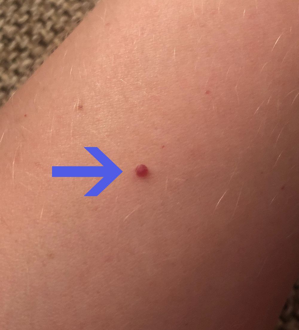 Representative clinical photograph of Cherry angioma
