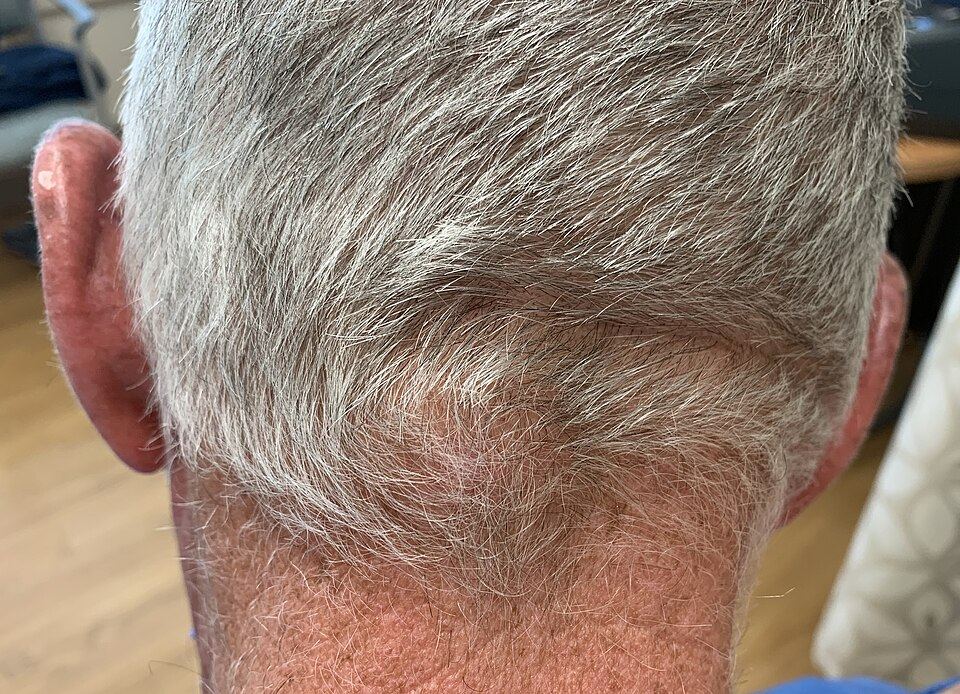 Representative clinical photograph of Epidermoid cyst