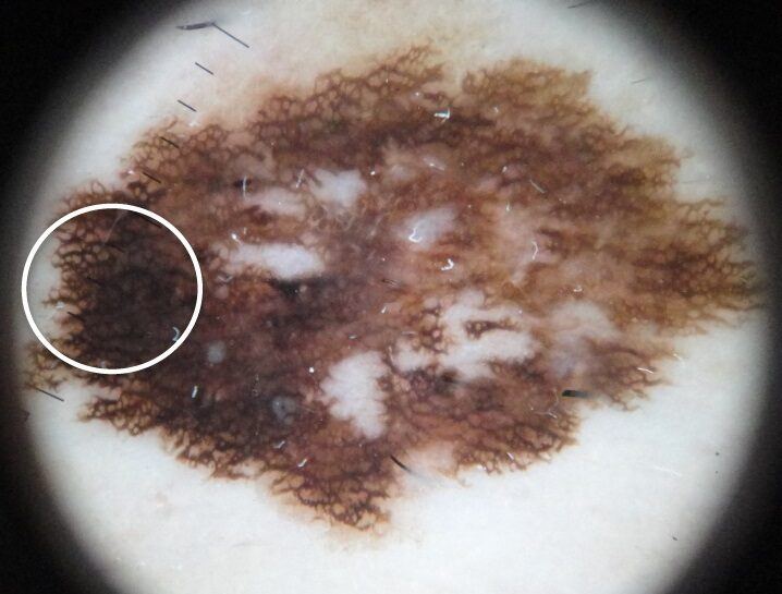 Dermoscopic view of a superficial spreading melanoma in situ