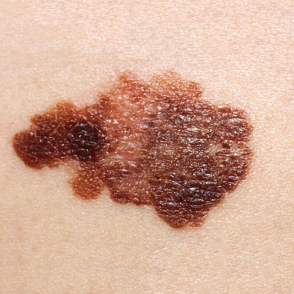 Clinical photograph of a melanoma showing asymmetry and variation in colour